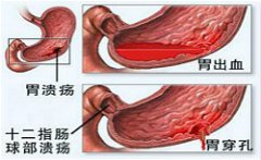 福州哪家医院治疗胃出血好？