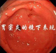 治疗胃窦炎要多少钱？