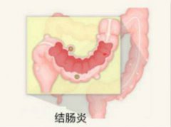结肠炎应该怎么治疗才好？