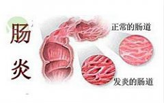 直肠炎的危害有哪些？