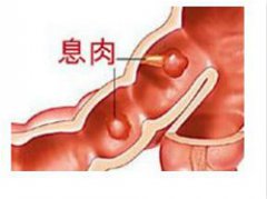 肠息肉切除哪家医院更专业？