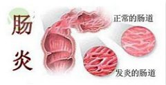 急性肠炎的危害不可小视！