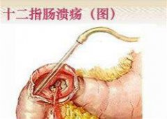 治疗十二指肠溃疡，选福州医博